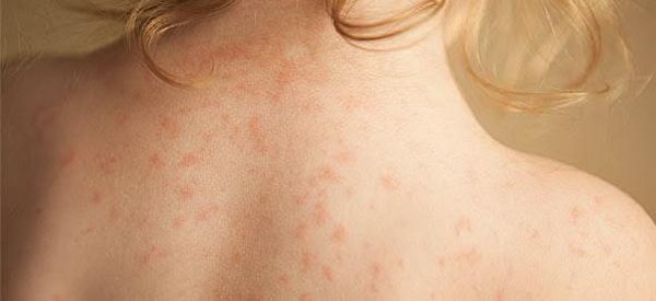 Μηνιγγίτιδα: Όλα οσα πρέπει να ξέρουμε μηνιγγίτιδα 