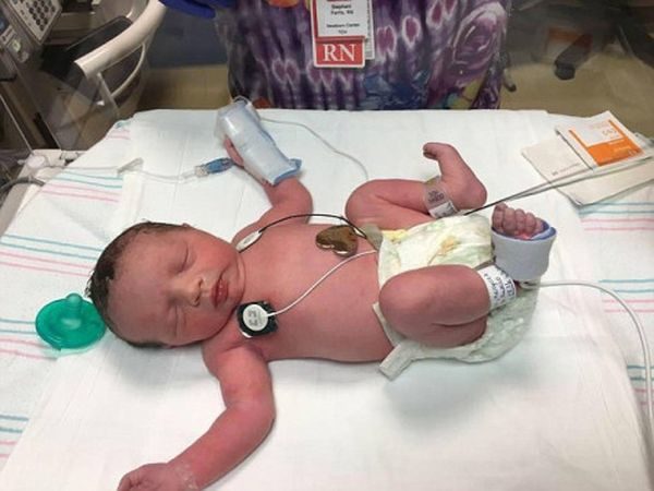 Απίστευτο: Αυτό το μωράκι γεννήθηκε δυο φορές! όγκος 